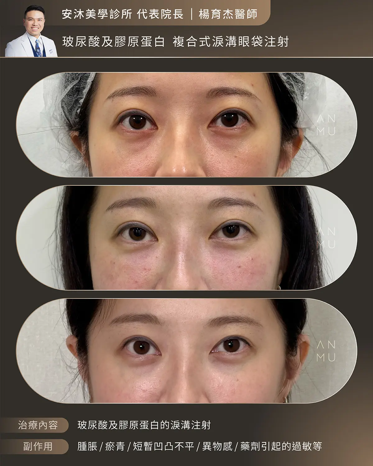 安沐社群 1 淚溝眼袋 新 03 2